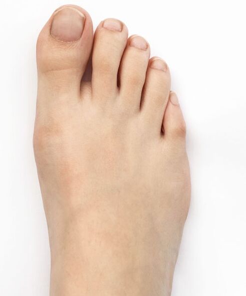 Curei meu polegar valgo com spray Hondro Sol Valgus
