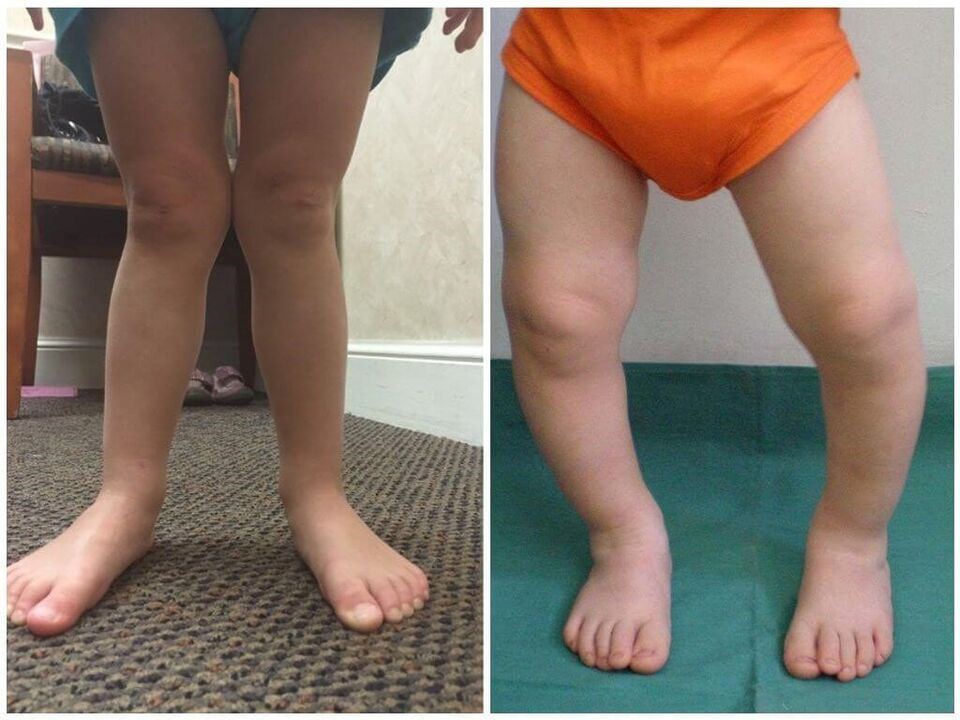 Deformação de Valgus em Crianças Causas