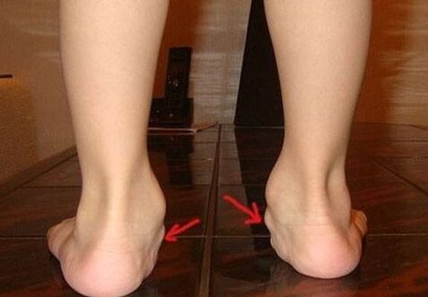 Deformação de Valgus dos pés em crianças