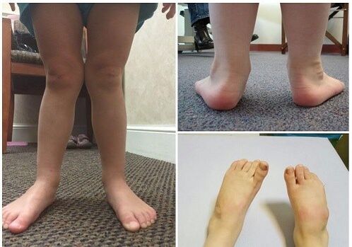 Deformação de Valgus em crianças