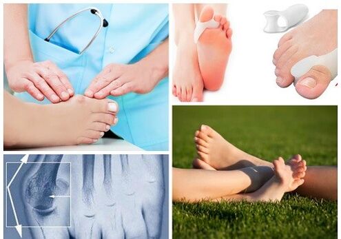 Tratamento da deformação de Valgus